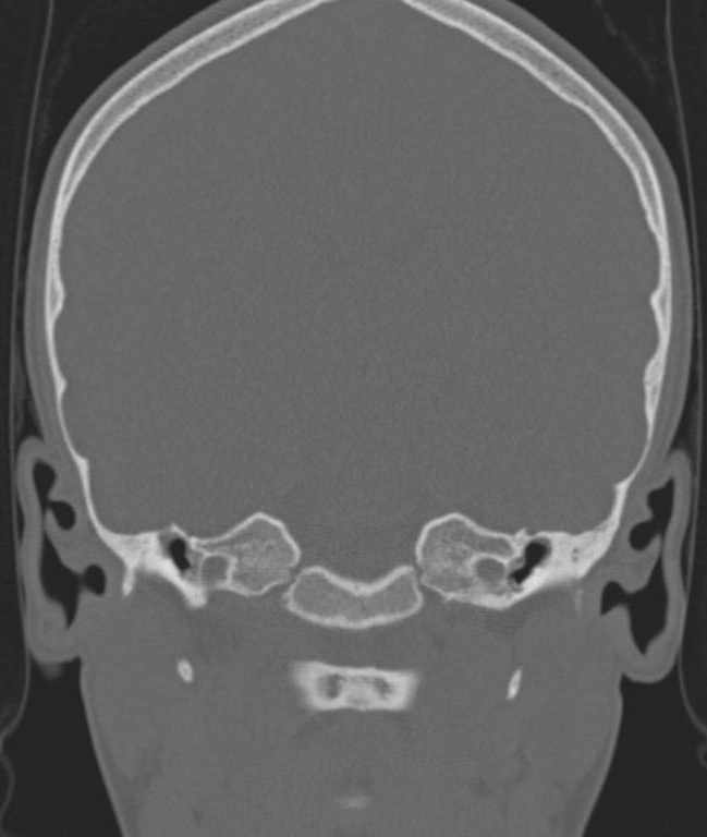 Cerebellar abscess (Radiopaedia 73727-84527 Coronal bone window 75).jpg