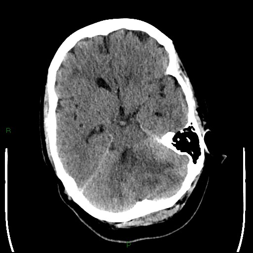 Cerebellar abscess (Radiopaedia 78135-90671 Axial non-contrast 39).jpg