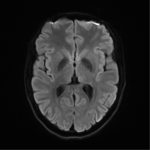 Cerebellar agenesis with hypoplastic pons (pontocerebellar hypoplasia) (Radiopaedia 57224-64138 Axial DWI 56).png