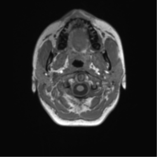 Cerebellar agenesis with hypoplastic pons (pontocerebellar hypoplasia) (Radiopaedia 57224-64138 Axial T1 4).png