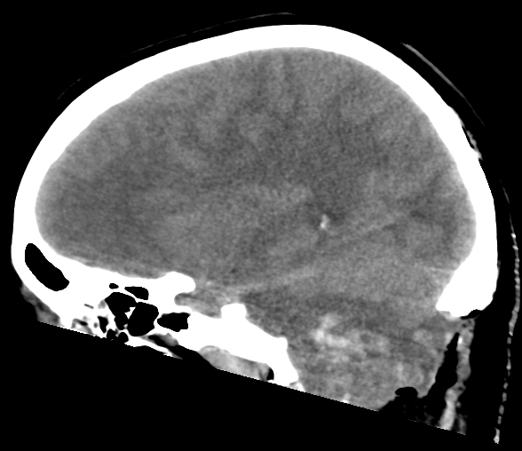 File:Cerebellar ependymoma complicated by post-operative subdural hematoma (Radiopaedia 83322-97737 C 13).png