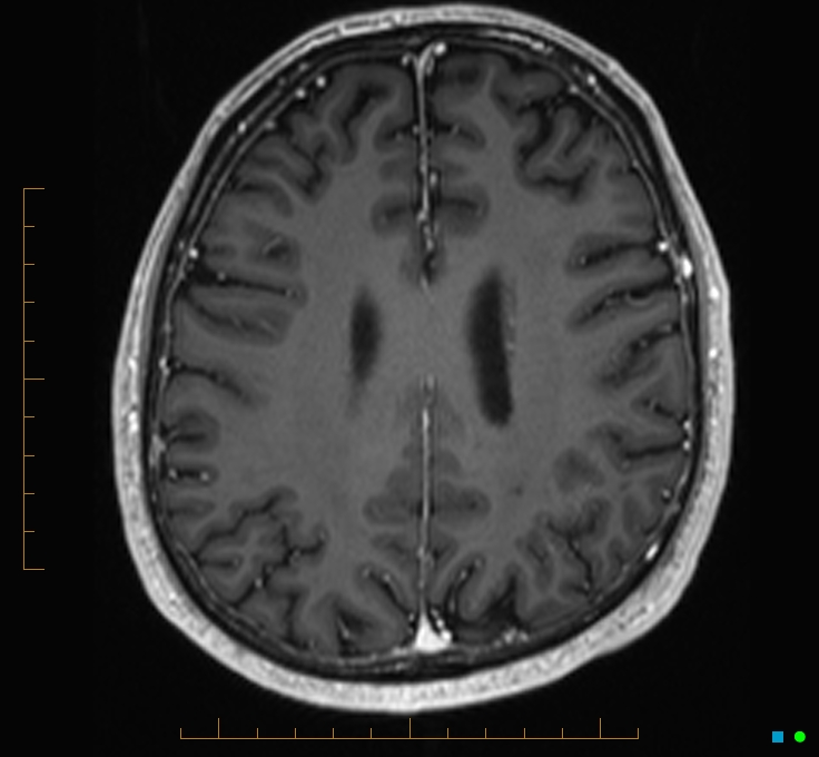 Cerebellar gangliocytoma (Radiopaedia 65377-74422 Axial T1 C+ 93).jpg