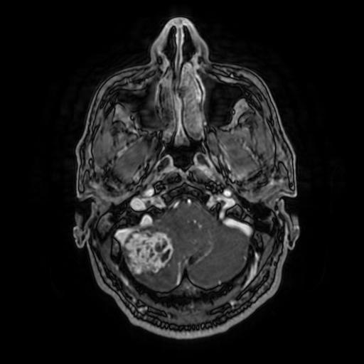 File:Cerebellar hemangioblastoma (Radiopaedia 88055-104622 Axial T1 C+ 39).jpg