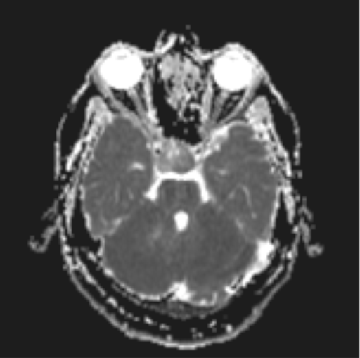 File:Cerebellar hemangioblastomas and pituitary adenoma (Radiopaedia 85490-101176 Axial ADC 11).png