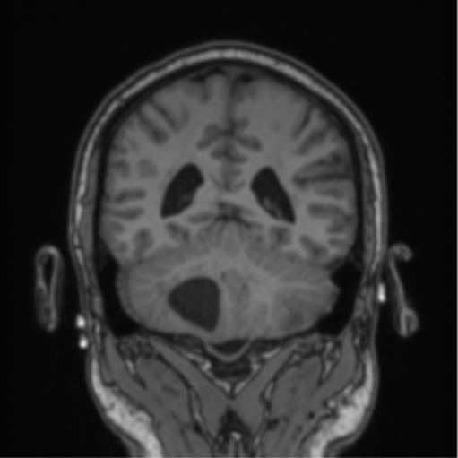 File:Cerebellar hemangioblastomas and pituitary adenoma (Radiopaedia 85490-101176 Coronal T1 34).png
