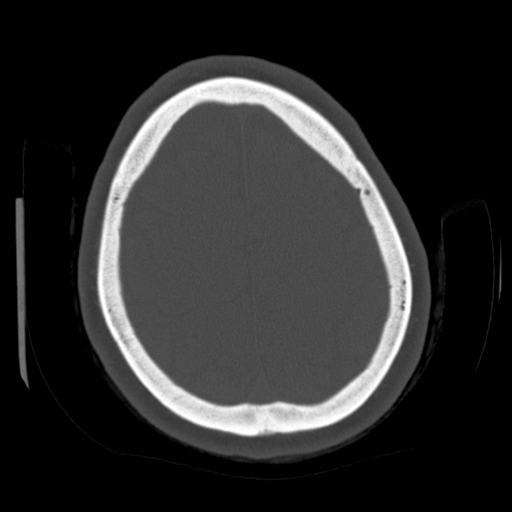File:Cerebellar metastasis (cystic appearance) (Radiopaedia 41395-44258 Axial bone window 56).png