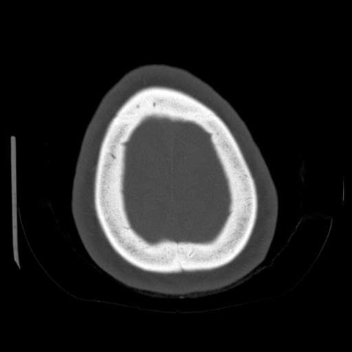 Cerebellar metastasis (cystic appearance) (Radiopaedia 41395-44258 Axial bone window 65).png