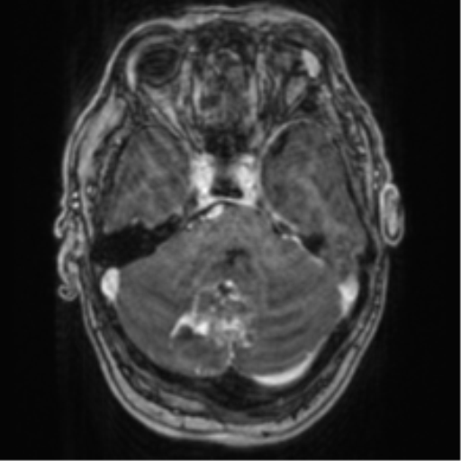 File:Cerebellar metastasis from lung adenocarcinoma (Radiopaedia 86690-102829 Axial T1 C+ 25).png