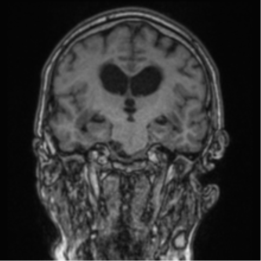 Cerebellar metastasis from lung adenocarcinoma (Radiopaedia 86690-102829 Coronal T1 53).png