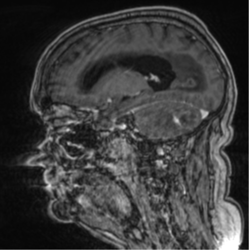 Cerebellar metastasis from lung adenocarcinoma (Radiopaedia 86690-102829 Sagittal T1 C+ 52).png