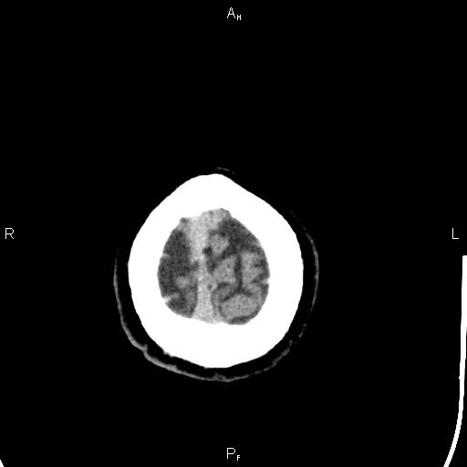 Cerebellopontine angle arachnoid cyst (Radiopaedia 85149-100704 Axial With contrast 51).jpg