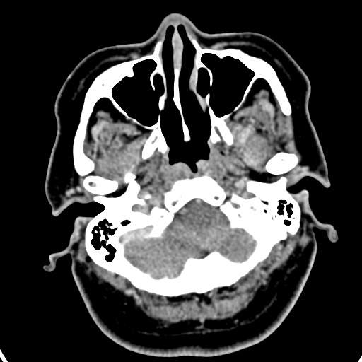 Cerebellopontine angle meningioma (Radiopaedia 35181-36714 A 48).jpg