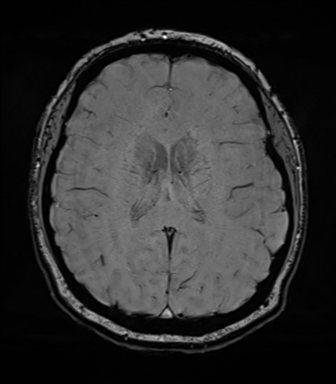 Cerebellopontine angle meningioma (Radiopaedia 48434-53348 Axial SWI 55).png