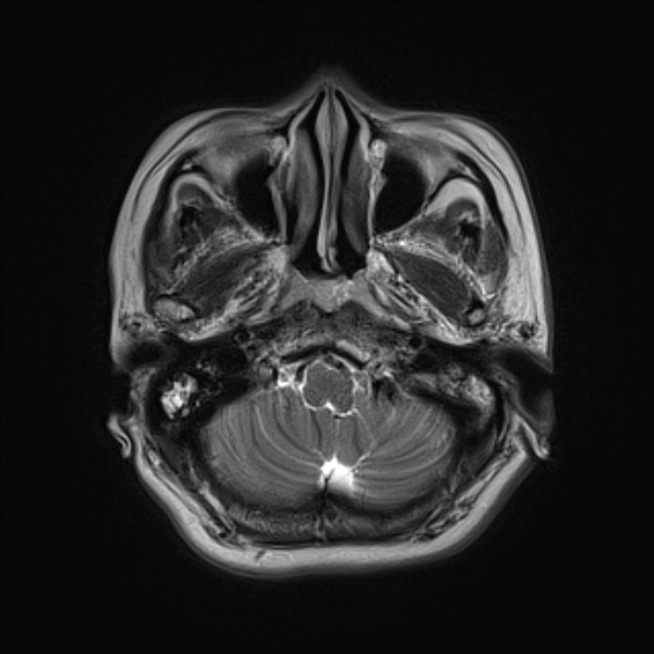 File:Cerebellopontine angle meningioma (Radiopaedia 53561-59591 Axial T2 4).jpg