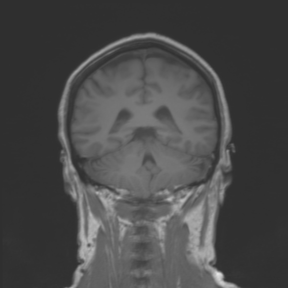 File:Cerebellopontine angle meningioma (Radiopaedia 53561-59591 Coronal T1 16).jpg