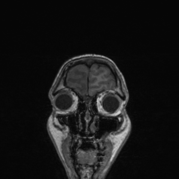 Cerebral abscess (Radiopaedia 24212-24478 Coronal T1 39).jpg