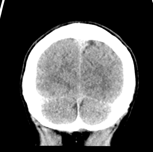 Cerebral abscess (Radiopaedia 60342-68008 Coronal non-contrast 55).png