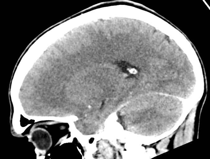 Cerebral abscess (Radiopaedia 60342-68008 Sagittal C+ delayed 19).png