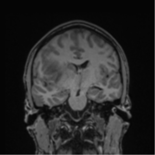 Cerebral abscess (Radiopaedia 60342-68009 Coronal T1 25).png