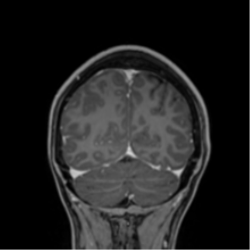 Cerebral abscess (Radiopaedia 60342-68009 H 7).png
