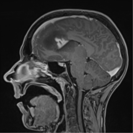 Cerebral abscess (Radiopaedia 60342-68009 J 31).png