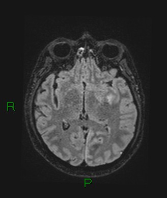 Cerebral abscess and subdural empyema (Radiopaedia 84436-99779 Axial FLAIR 46).jpg