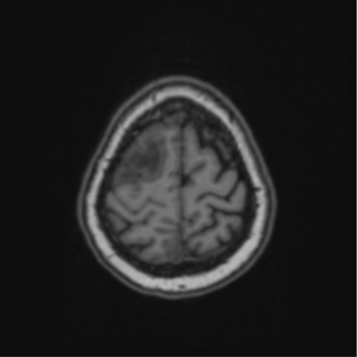 Cerebral abscess from pulmonary arteriovenous malformation (Radiopaedia 86275-102291 Axial T1 65).png