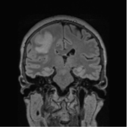Cerebral abscess from pulmonary arteriovenous malformation (Radiopaedia 86275-102291 Coronal FLAIR 41).png