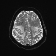 Cerebral amyloid angiopathy-related inflammation (Radiopaedia 74836-85849 Axial DWI 22).jpg