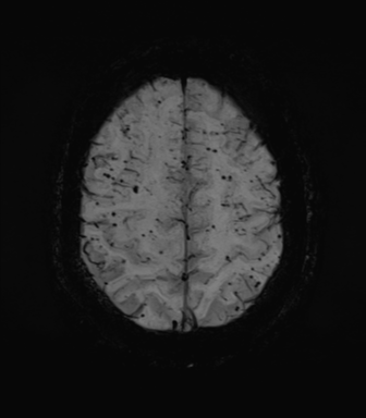 Cerebral amyloid angiopathy (Radiopaedia 46082-50433 Axial SWI MIP 63).png