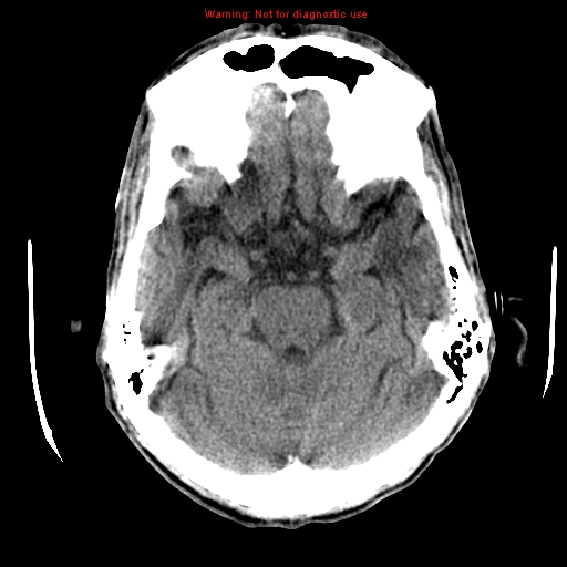 File:Cerebral and orbital tuberculomas (Radiopaedia 13308-13310 Axial non-contrast 29).jpg