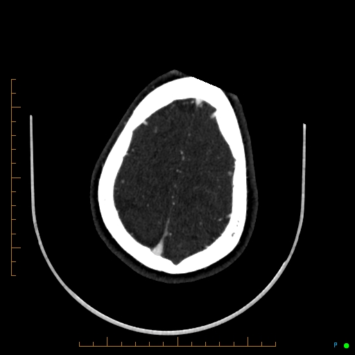 Cerebral arteriovenous malformation (AVM) (Radiopaedia 78162-90706 Axial CTA 232).jpg