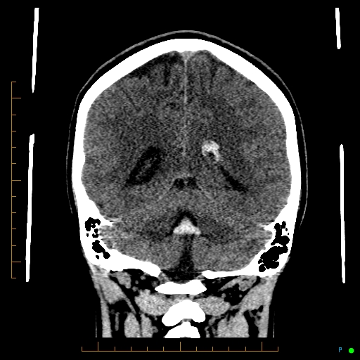 File:Cerebral arteriovenous malformation (AVM) (Radiopaedia 78162-90706 Coronal non-contrast 67).jpg