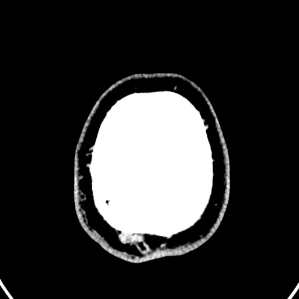 Cerebral arteriovenous malformation (Radiopaedia 37182-39012 Axial non-contrast 48).jpg