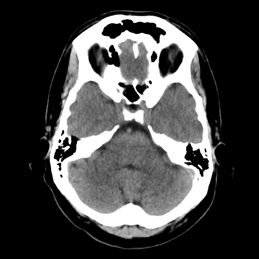 File:Cerebral arteriovenous malformation (Radiopaedia 39259-41505 Brain Ax 5mm 7).png