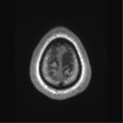 Cerebral arteriovenous malformation (Radiopaedia 39259-41506 Axial T1 74).png