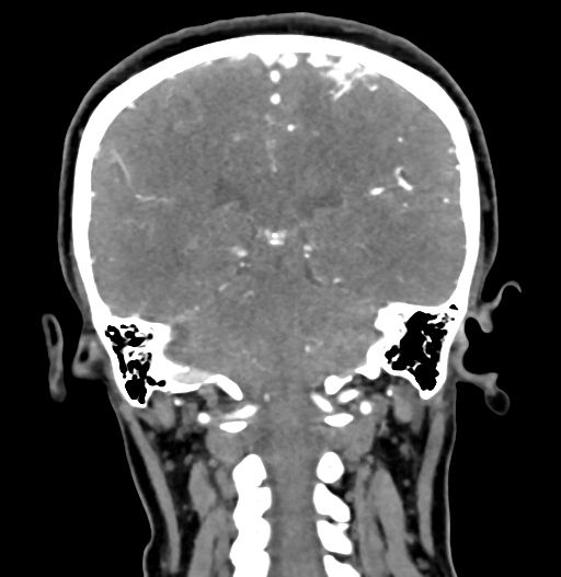 Cerebral arteriovenous malformation (Radiopaedia 73830-84645 C 64).jpg