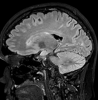 File:Cerebral arteriovenous malformation (Radiopaedia 74411-85746 Sagittal FLAIR 44).jpg