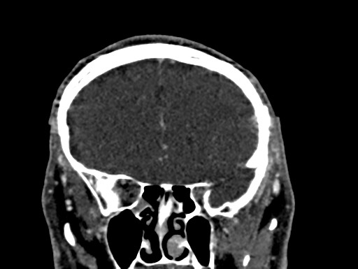 Cerebral arteriovenous malformation (Radiopaedia 78188-90746 Coronal C+ delayed 30).jpg