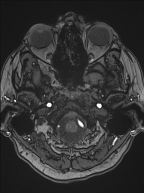 Cerebral arteriovenous malformation (Radiopaedia 84015-99245 Axial TOF 56).jpg