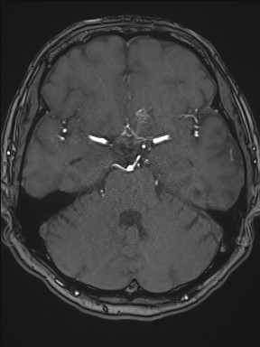 Cerebral arteriovenous malformation (Radiopaedia 84015-99245 Axial TOF 96).jpg