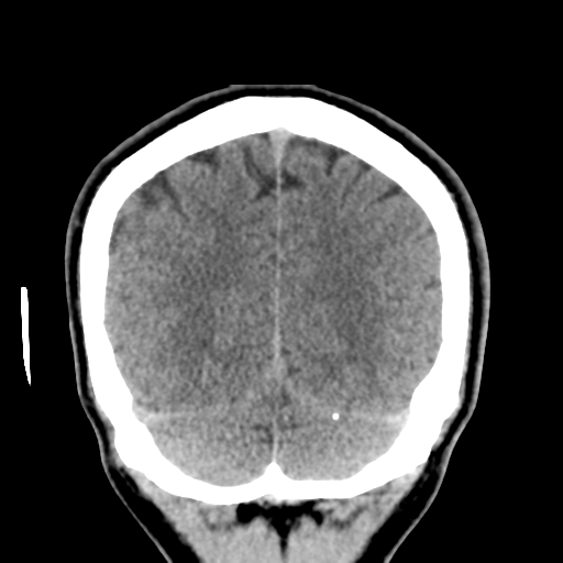 Cerebral arteriovenous malformation (Spetzler-Martin grade 2) (Radiopaedia 41262-44076 Coronal non-contrast 52).png