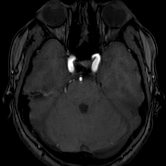 Cerebral arteriovenous malformation at posterior body of corpus callosum (Radiopaedia 74111-84925 Axial MRA 59).jpg