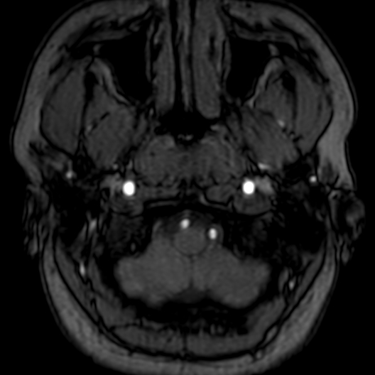 Cerebral arteriovenous malformation at posterior body of corpus callosum (Radiopaedia 74111-84925 Axial MRA 6).jpg