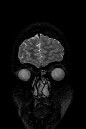 Cerebral arteriovenous malformation at posterior body of corpus callosum (Radiopaedia 74111-84925 Coronal T2 13).jpg