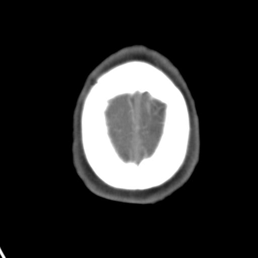 Cerebral arteriovenous malformation with hemorrhage (Radiopaedia 28773-29073 A 6).jpg