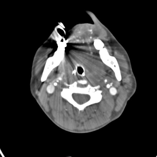 Cerebral arteriovenous malformation with hemorrhage (Radiopaedia 28773-29073 A 63).jpg