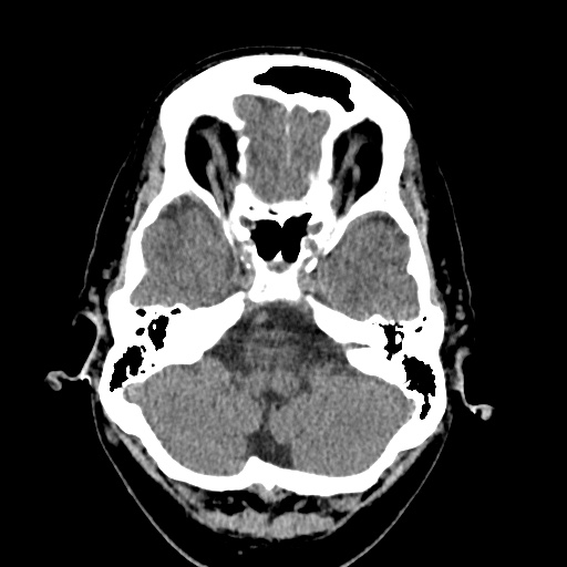 Cerebral arteriovenous malformation with lobar hemorrhage (Radiopaedia 35598-37117 Axial non-contrast 10).jpg