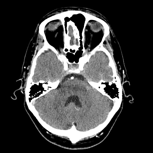 File:Cerebral arteriovenous malformation with lobar hemorrhage (Radiopaedia 35598-57216 A 17).jpg