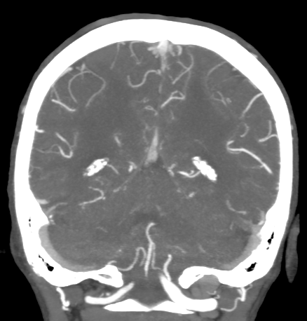 Cerebral arteriovenous malformation with lobar hemorrhage (Radiopaedia 44725-48511 B 41).png